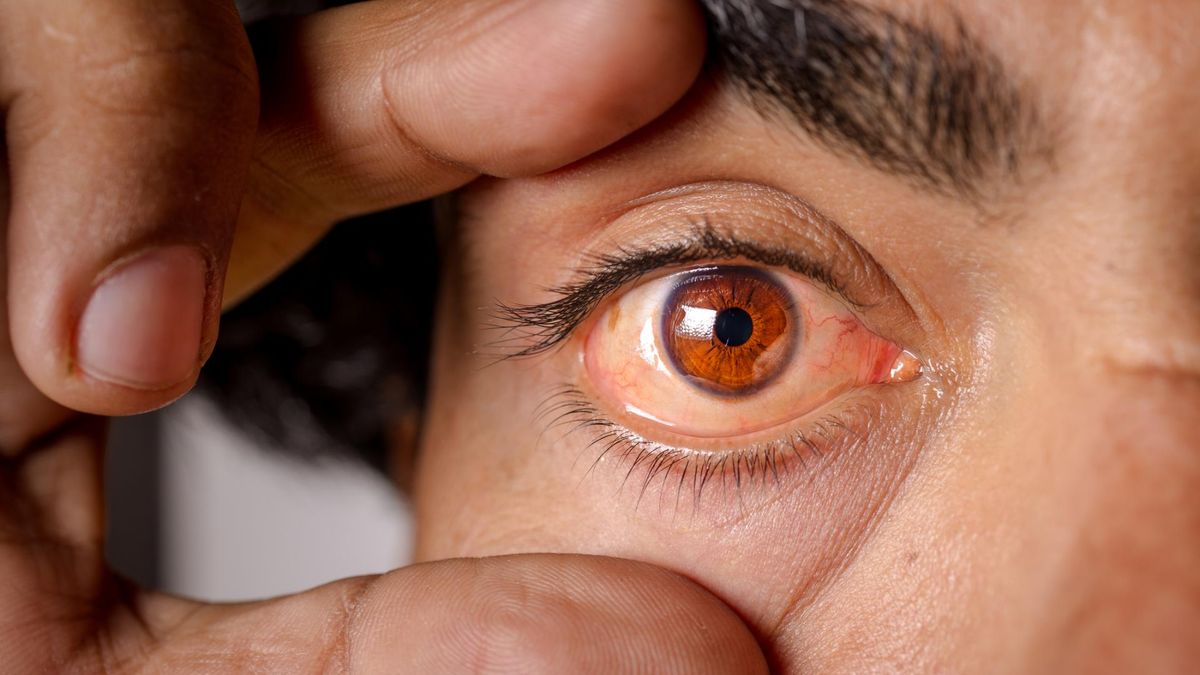 Objaw wysokiego cholesterolu widać w oczach