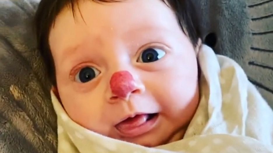 Urodziła się z "nosem klauna". Wiemy, jak dziś wygląda