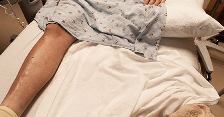 Powikłania po koronawirusie. U pacjentów z COVID-19 może dojść do rozwoju gangreny