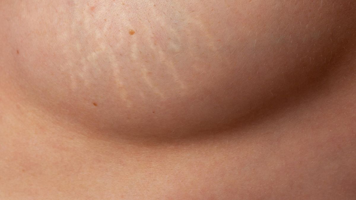 Rozstępy na piersiach to wrzeciownowate pręgi, pojawiające się na skórze wskutek zerwania włókien kolagenowych