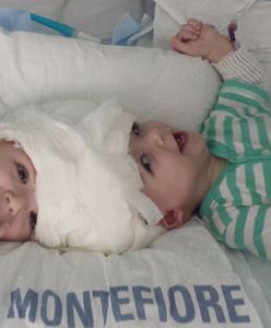 Po 27-godzinnej operacji rozdzielono bliźnięta syjamskie