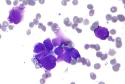 Jest przełom w walce z rakiem? Naukowcy wynaleźli szczepionkę