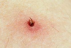 Walka z boreliozą na ostatniej prostej. Śląscy naukowcy o krok od przełomowego odkrycia