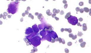 Jest przełom w walce z rakiem? Naukowcy wynaleźli szczepionkę