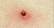 Walka z boreliozą na ostatniej prostej. Śląscy naukowcy o krok od przełomowego odkrycia