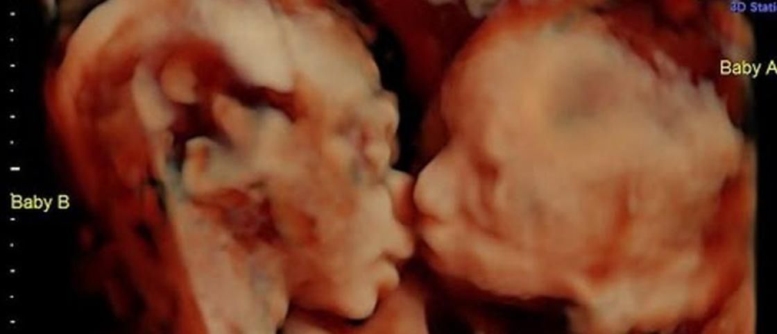 USG 3D bliźniaczek, które dają sobie całusa