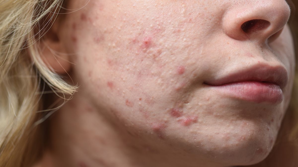 Jak dbać o cerę trądzikową? 