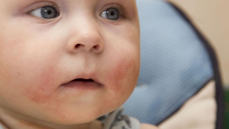 Co wiesz o alergii pokarmowej u dzieci? (WIDEO)