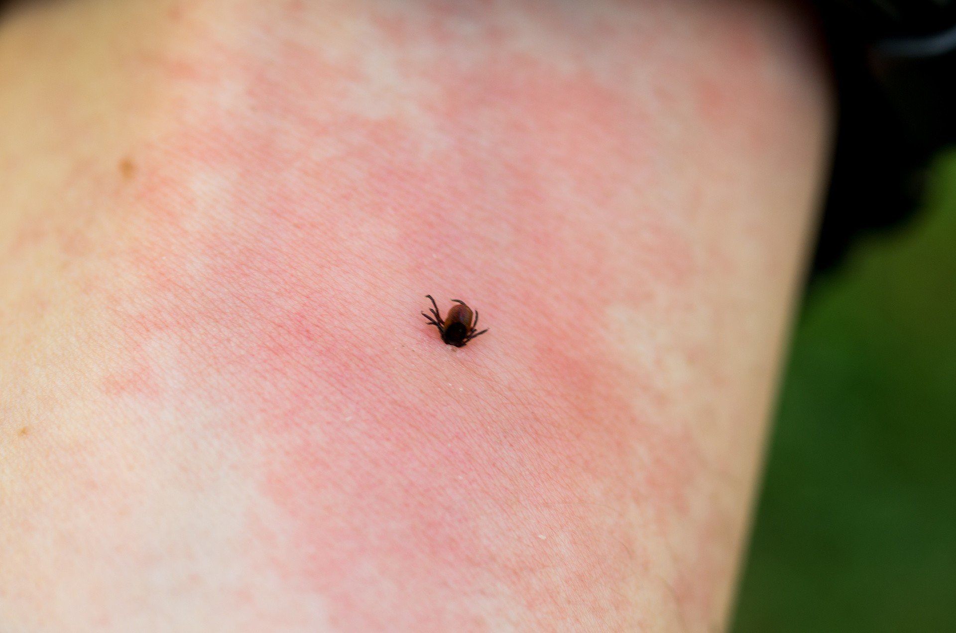 Rumień po kleszczu należy bacznie obserwować, ponieważ może wskazywać na zakażenie krętkami Borrelia.