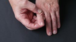 Bywa mylona z reumatyzmem. Drętwienie dłoni jest pierwszym objawem