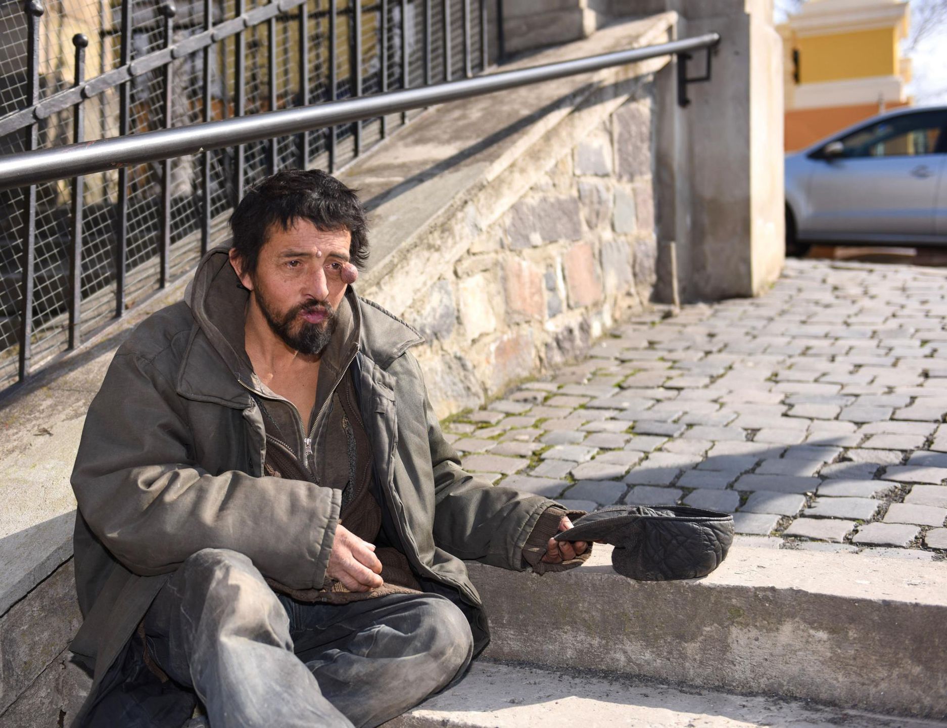 Mężczyzna cierpiący na nerwiakowłókniakowatość - zmiany skórne w okolicy twarzy. 