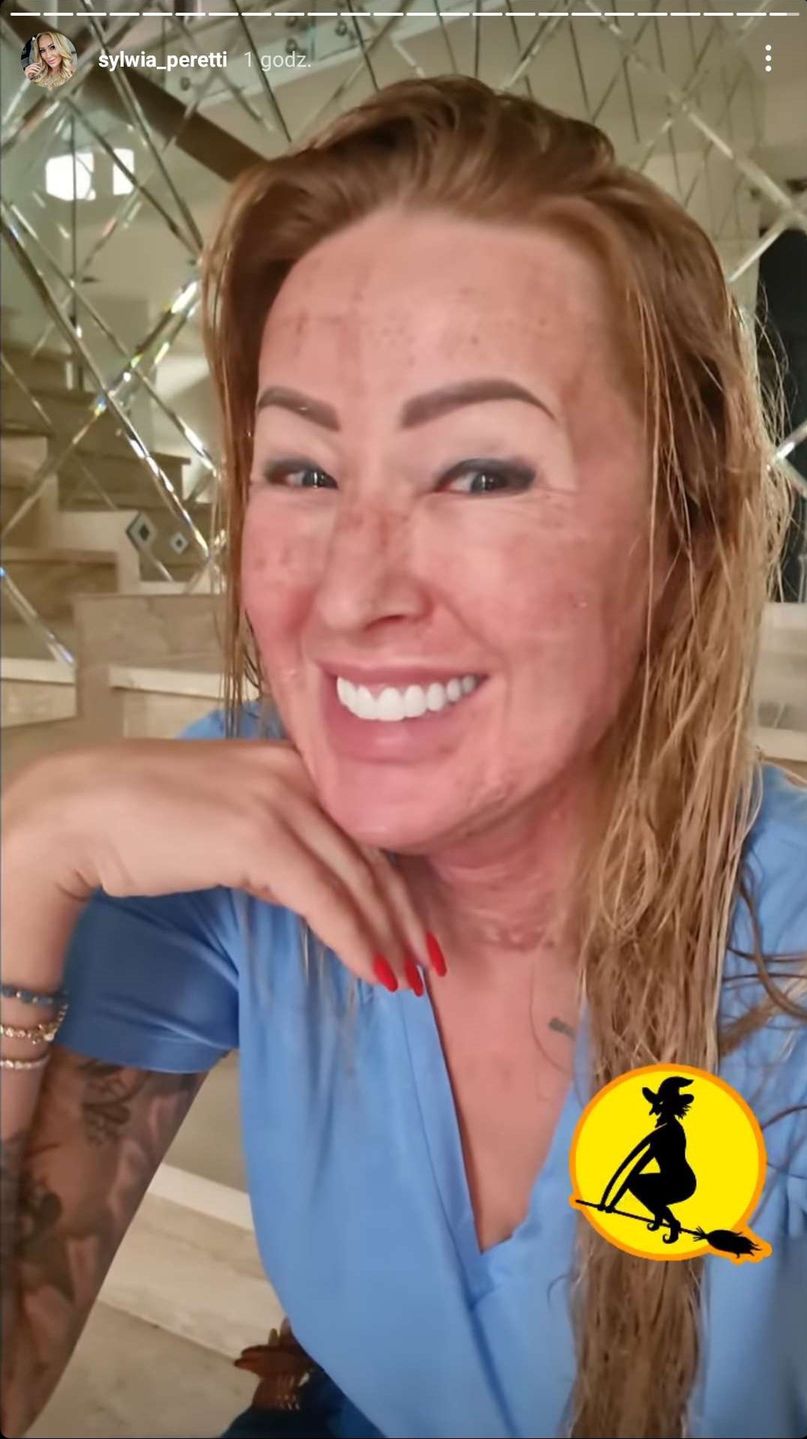 Sylwia Peretti pokazuje kolejny etap po zabiegu laserowym. Jest lepiej? 