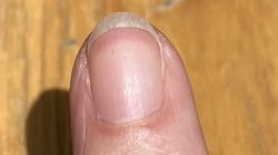 Pojawia się na paznokciach nawet u 80 proc. chorych. Znak, że wątroba wysiada