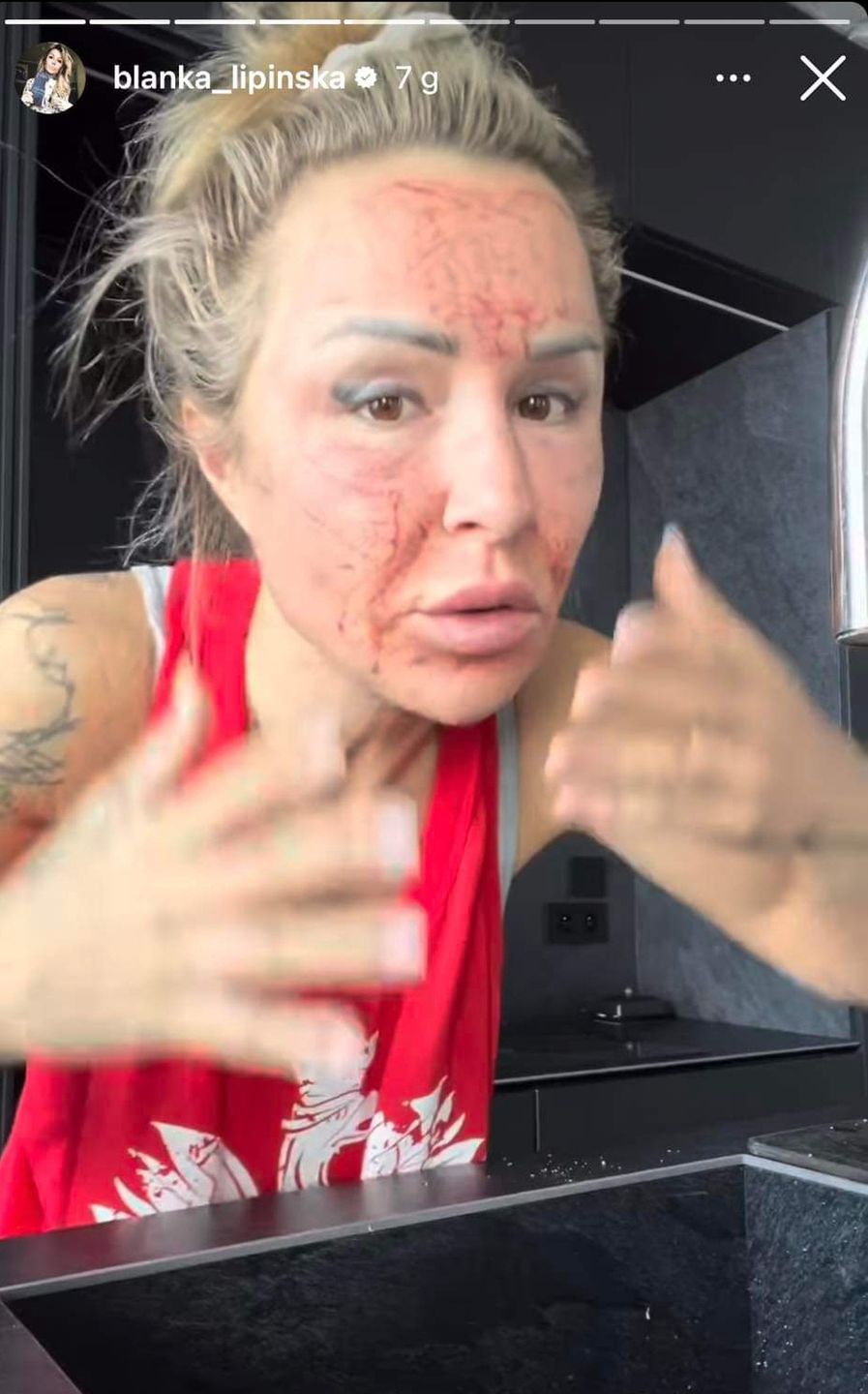 Blanka Lipińska pokazała zakrwawioną twarz