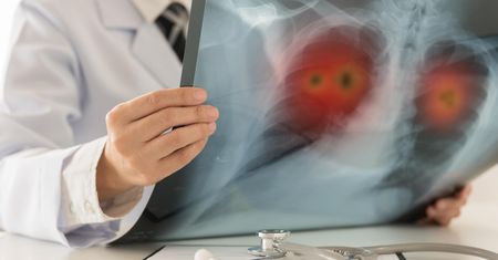 Lobektomia i pulmonektomia w leczeniu raka płuc