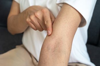 Siateczka na skórze w kolorze sinym lub fioletowym? To może być znak problemów z krążeniem