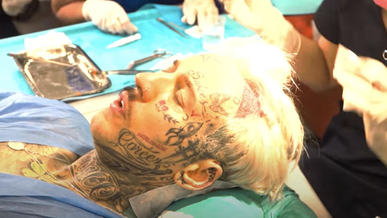 Stifler w trakcie przeszczepu włosów | fot. YouTube