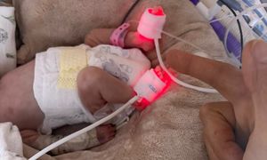 Zosia ważyła 700 g. Lekarze z Białegostoku zastosowali innowacyjną terapię