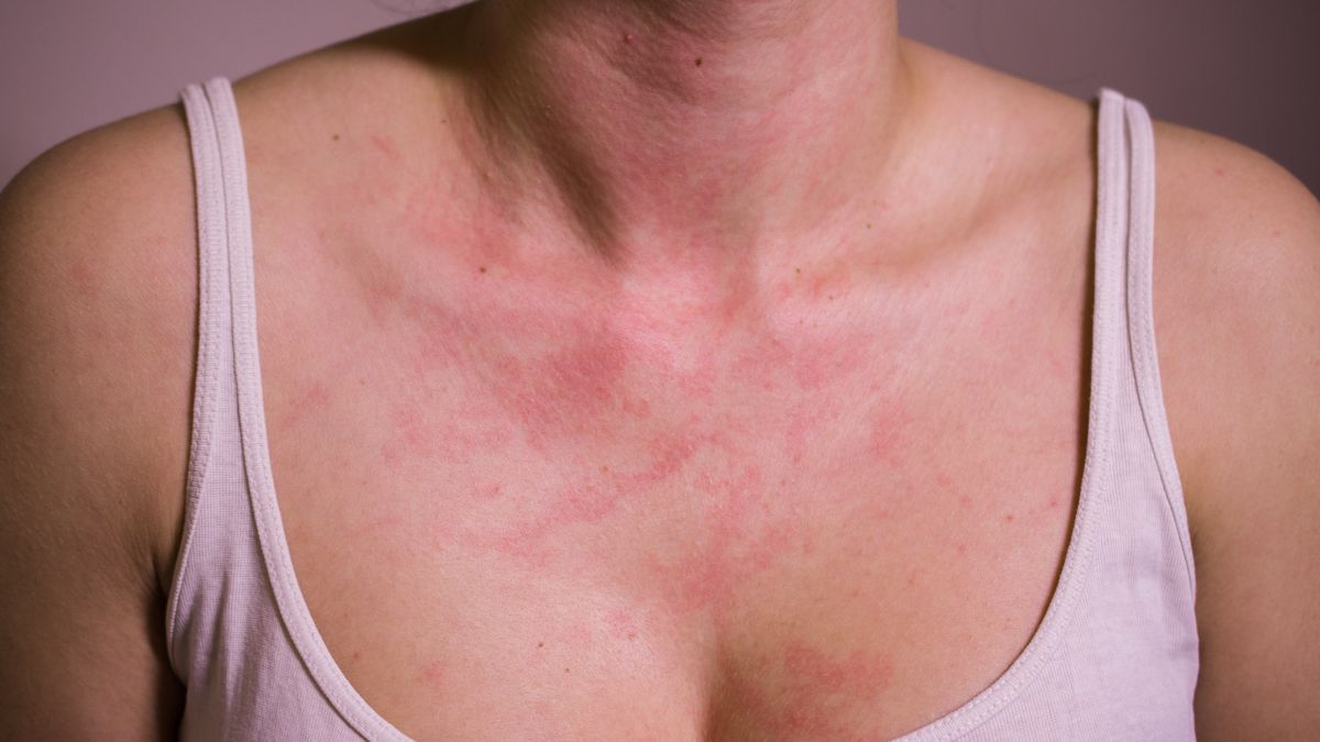 Wysypka na szyi 
