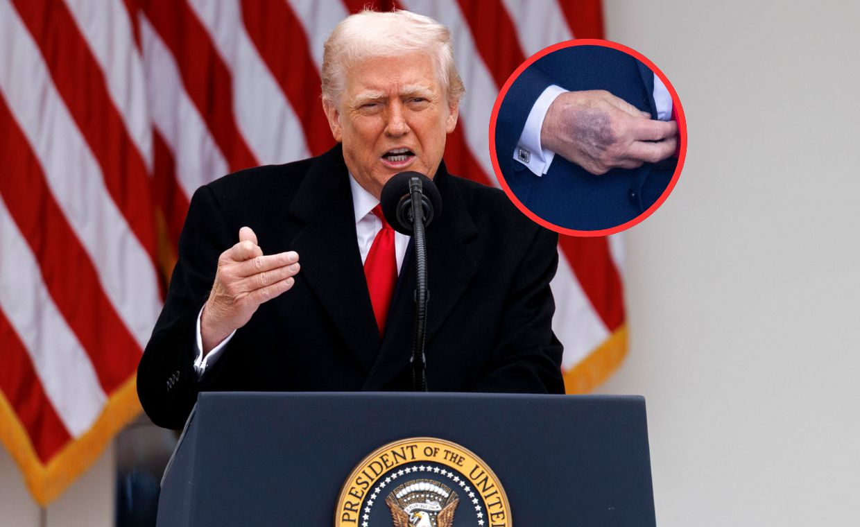 Siniaki na dłoniach Trumpa. Zaskakujące tłumaczenie prezydenta