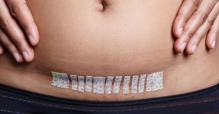 Usunięto jej macicę, gdy miała 39 lat. "Blizna to moje drugie życie"