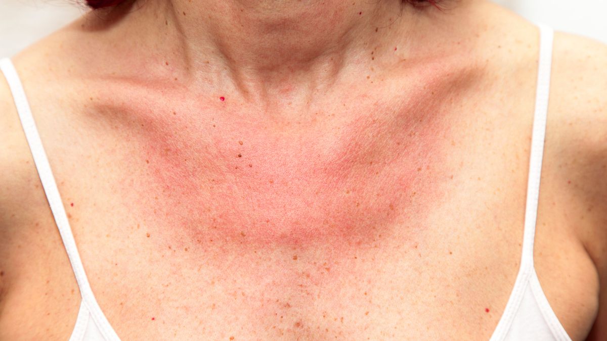 W przypadku alergii na słońce zmiany skórne występują głównie na dekolcie, szyi, przedramionach, ramionach i na stopach, rzadziej na twarzy.