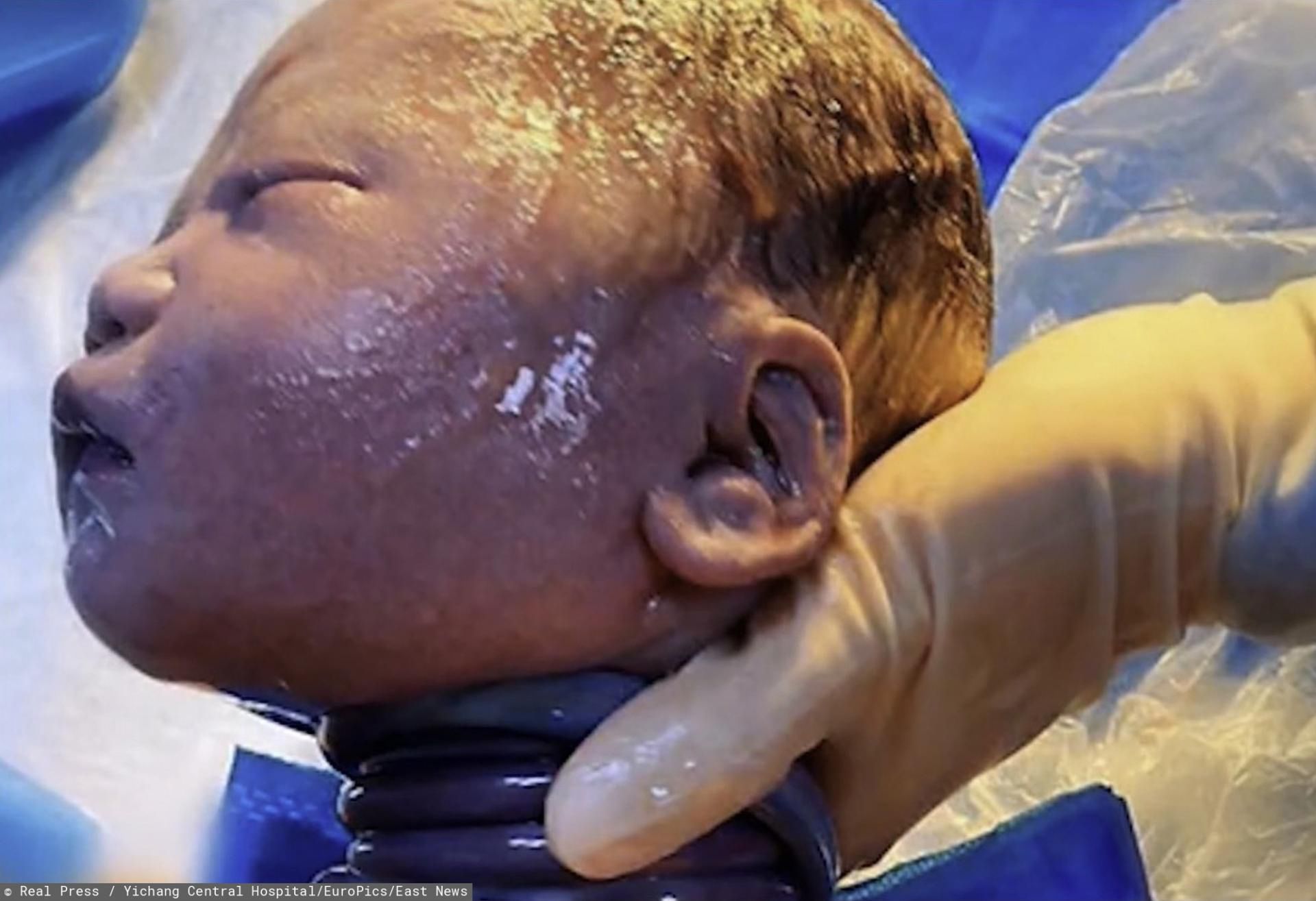 Pępowina wokół szyi dziecka