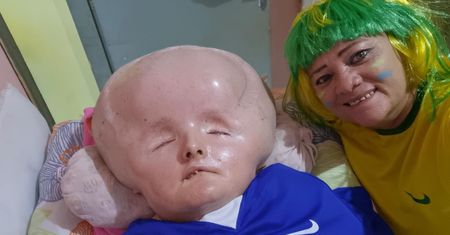 Mówili, że umrze po porodzie. Głowa 29-latki urosła już trzykrotnie