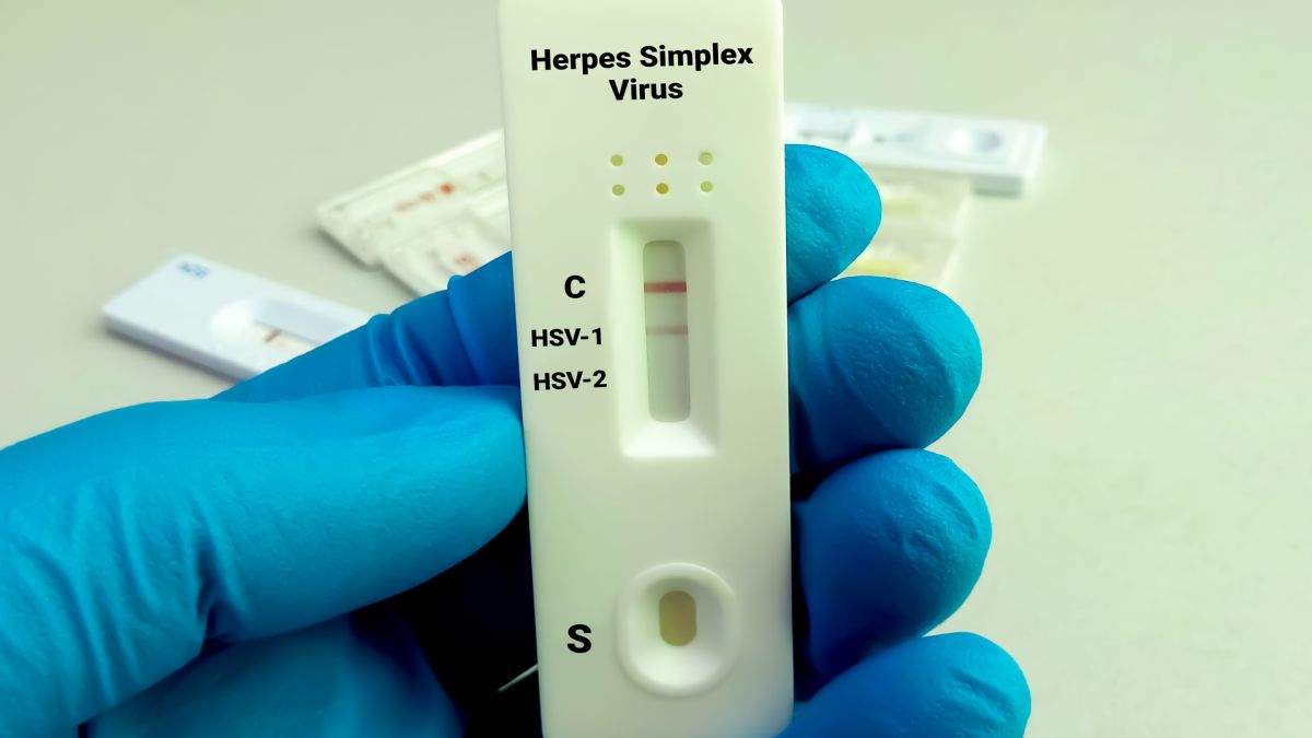 Wirus opryszczki może sprzyjać chorobie Alzheimera