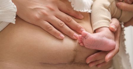 Elective C-sections?