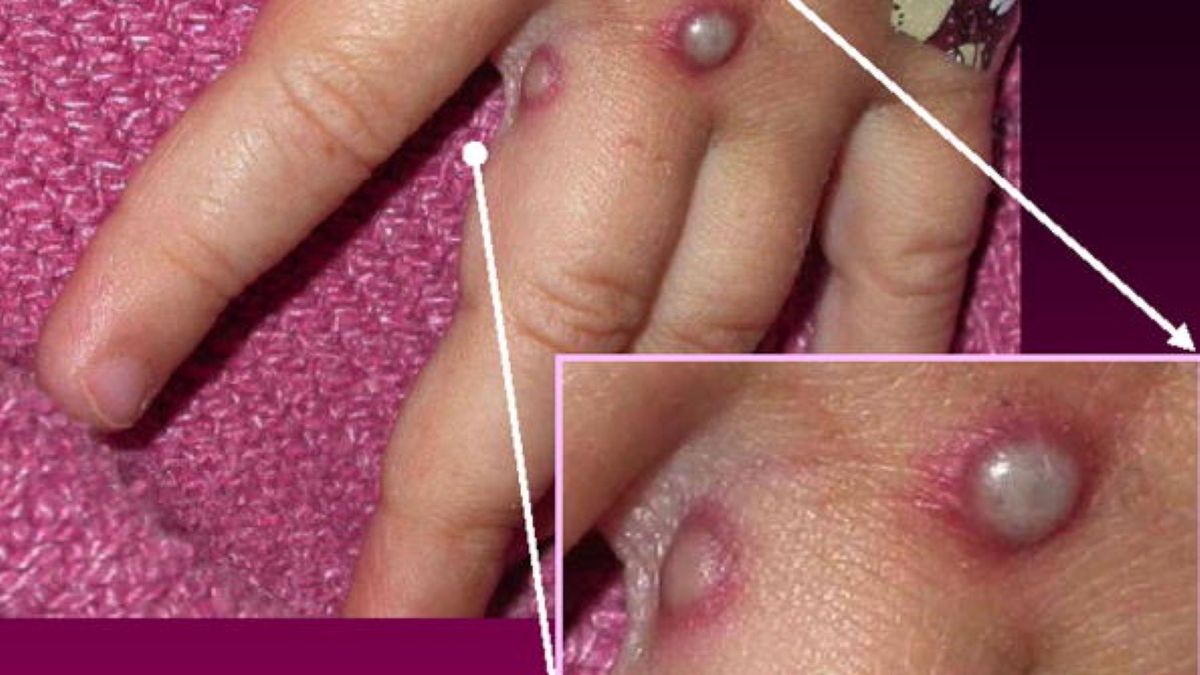 Światowa Organizacja Zdrowia przedstawiła obawy odnośnie do małpiej ospy