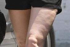 Gwiazda straszy cellulitem