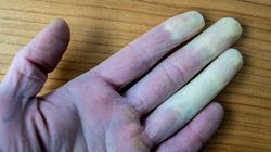 Palce stają się sine na mrozie? Może za tym stać jedno zaburzenie