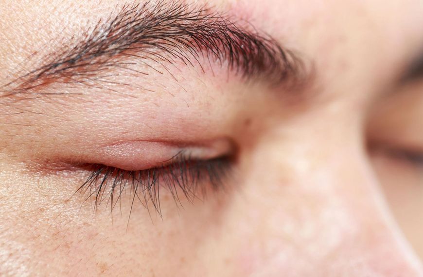 Jęczmień na oku może świadczyć o zakażeniu gronkowcem. 