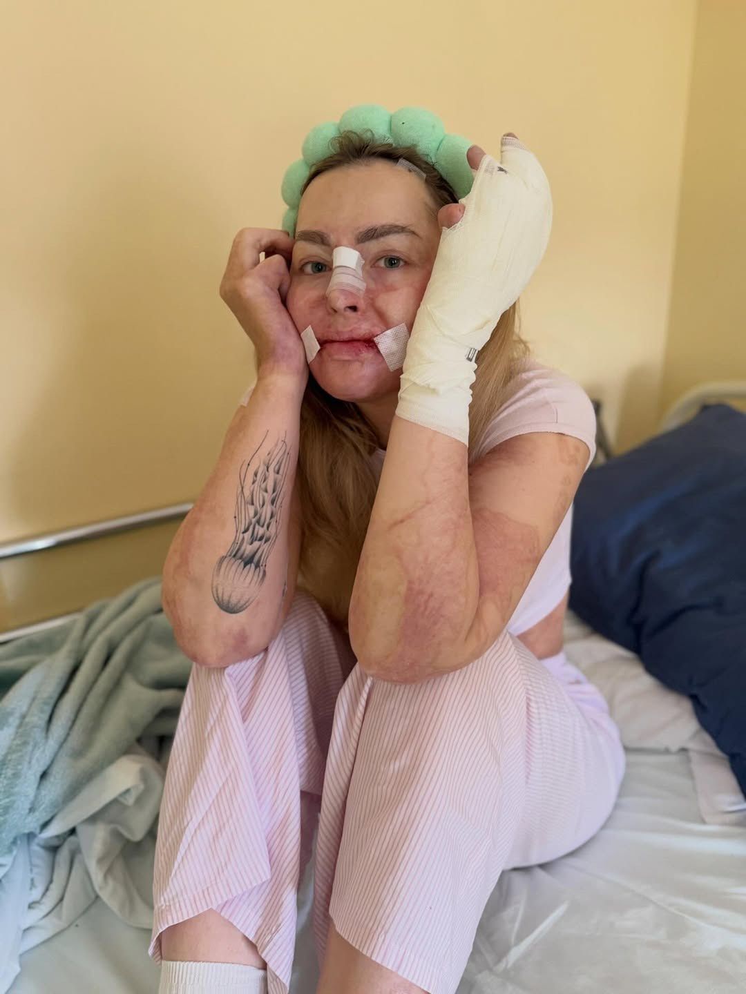 Tiktokerka, która płonęła żywcem, przeszła kolejną operację