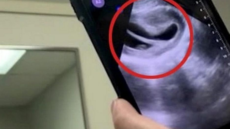 To się zdarza raz na 500 milionów. Mama z macicą w kształcie serca urodziła bliźniaki