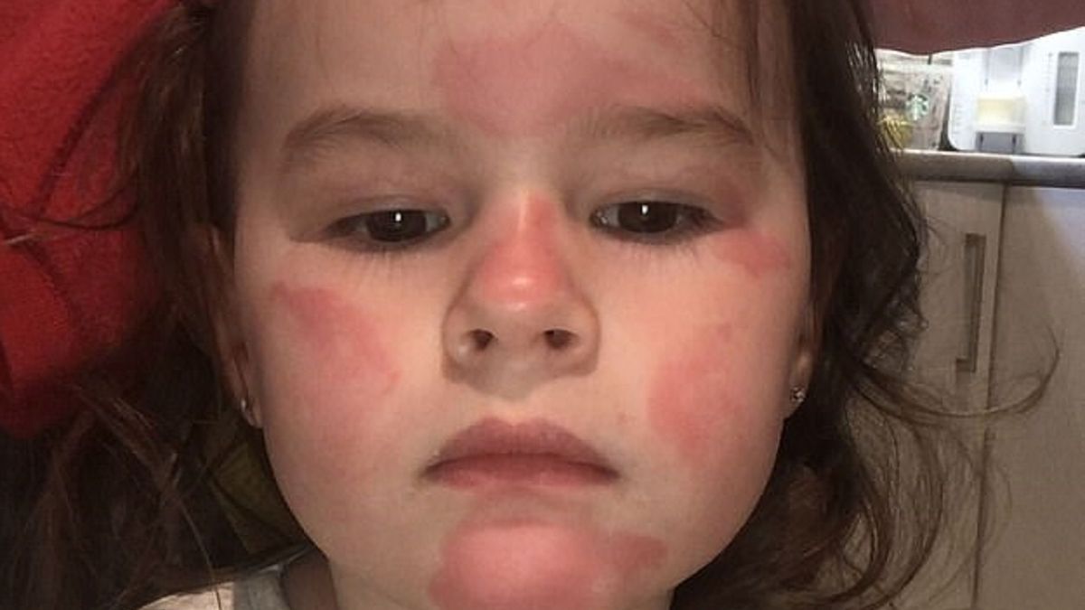 Posmarowała córkę balsamem. Po kilku sekundach trzylatka zaczęła krzyczeć