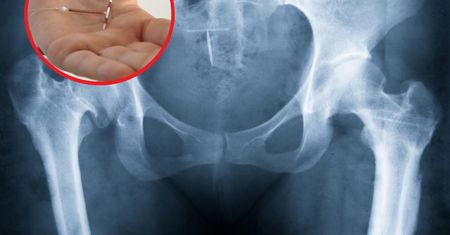 Niebezpieczny trend na TikToku. Kobiety samodzielnie usuwają wkładki domaciczne. Lekarze apelują o rozsądek: Nie warto ryzykować