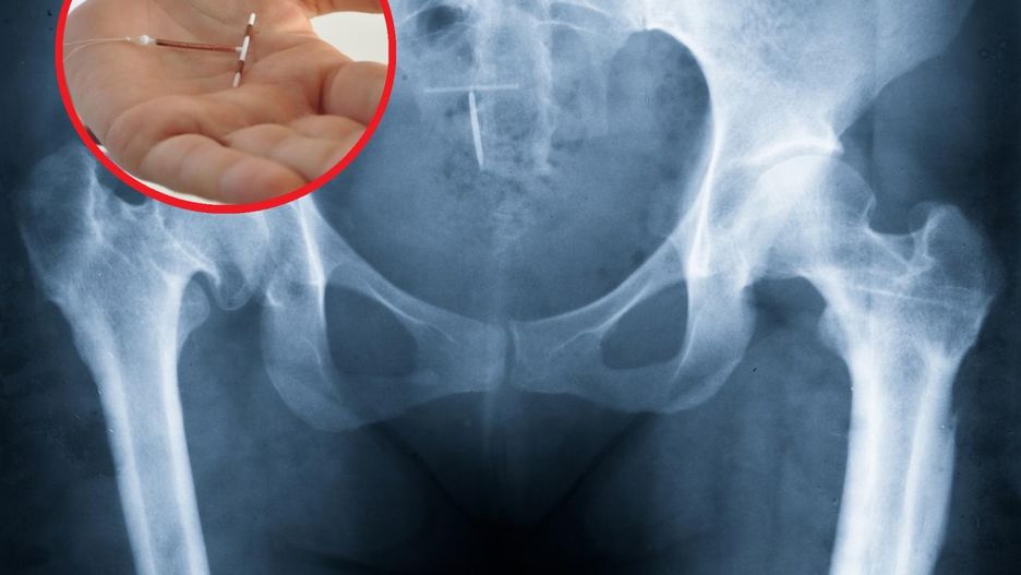 Niebezpieczny trend na TikToku. Kobiety samodzielnie usuwają wkładki domaciczne. Lekarze apelują o rozsądek: Nie warto ryzykować