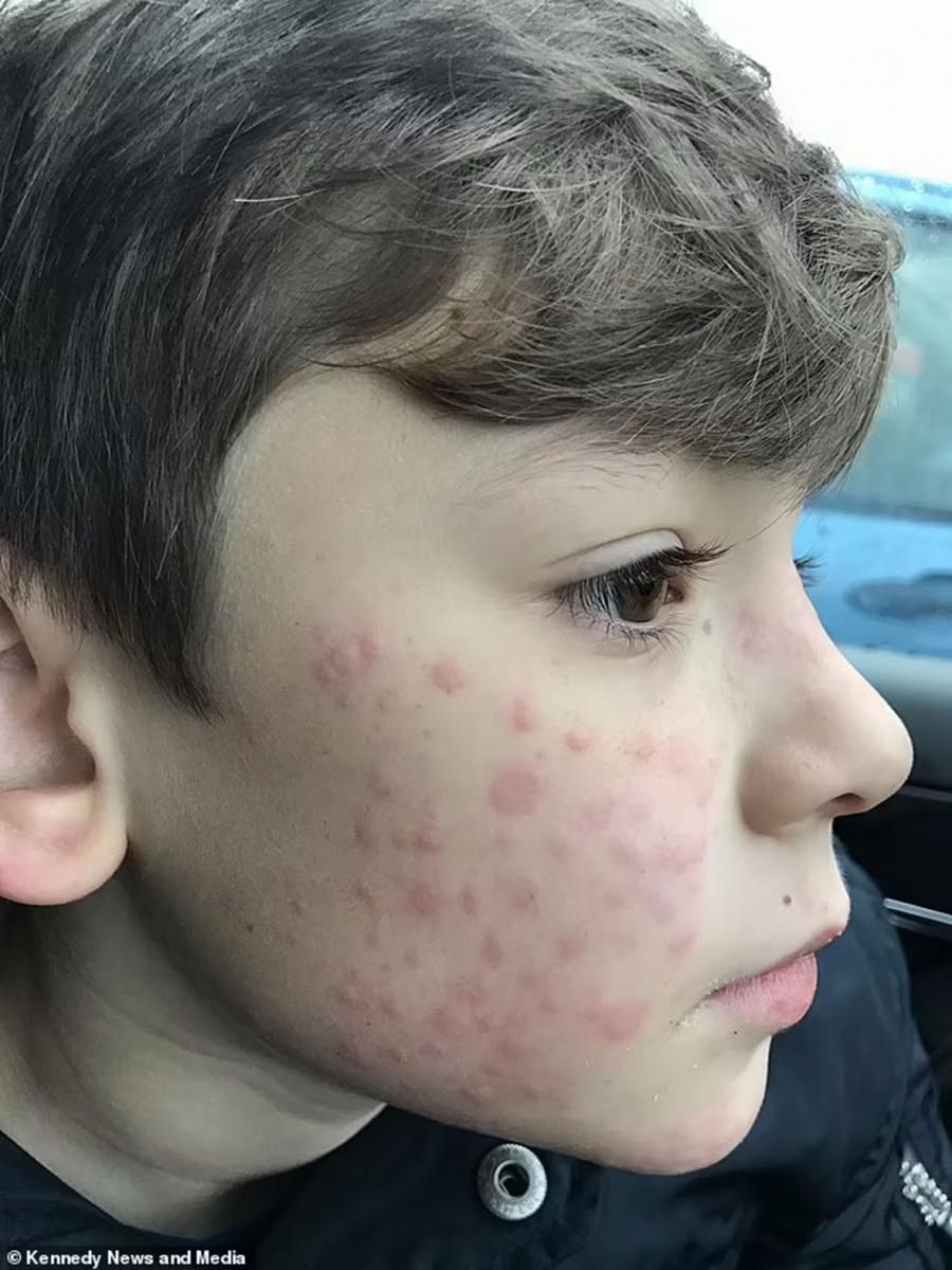 Chłopiec jest uczulony na zimno