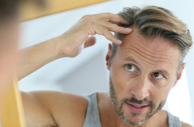 Problem łysienia u mężczyzn - kiedy warto zdecydować się na przeszczep włosów?