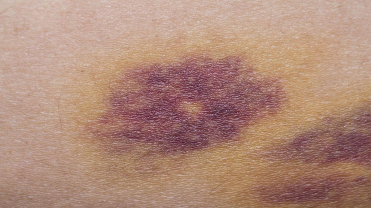 Siniaki na skórze najczęściej powstają w wyniku uderzenia.