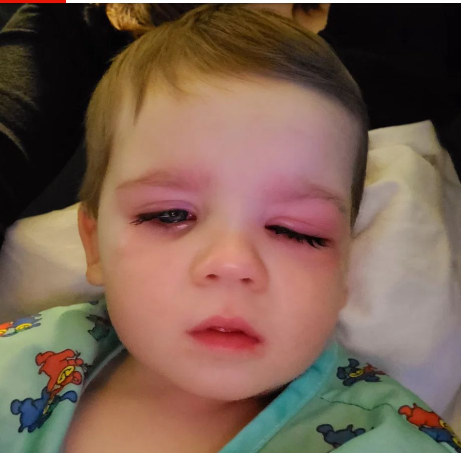 Zakażenie oka wywołane pleśnią