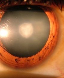 PiS szykuje zmianę dla chorych na zaćmę. Będzie refundacja