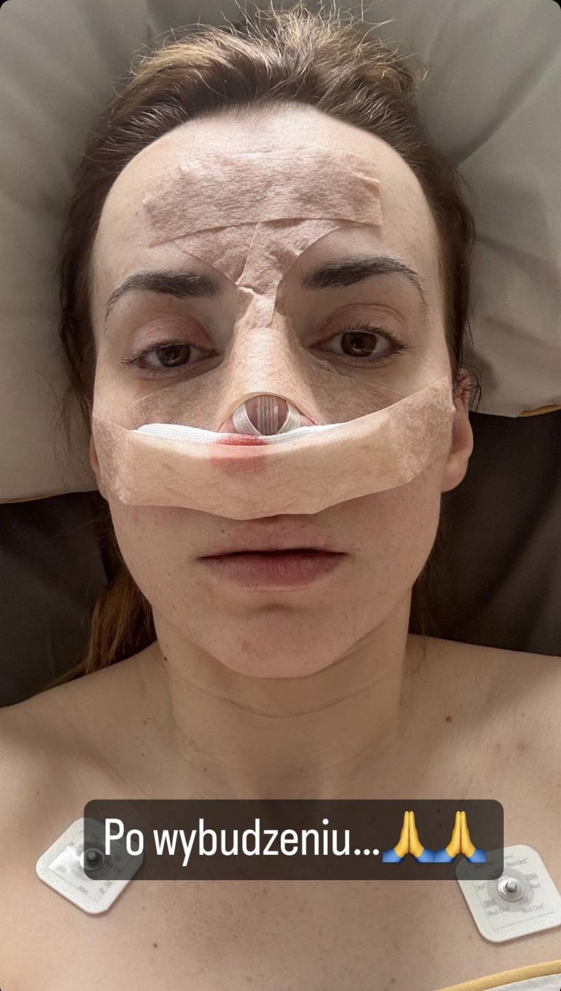 Marianna Schreiber przeszła operację nosa