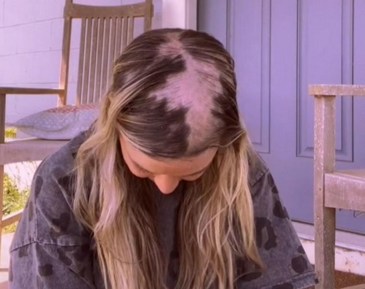 Przestała przyjmować tabletki antykoncepcyjne. 25-latka pokazuje tragiczne skutki