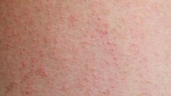 Zioła zakazane latem. Objawy zauważysz na skórze