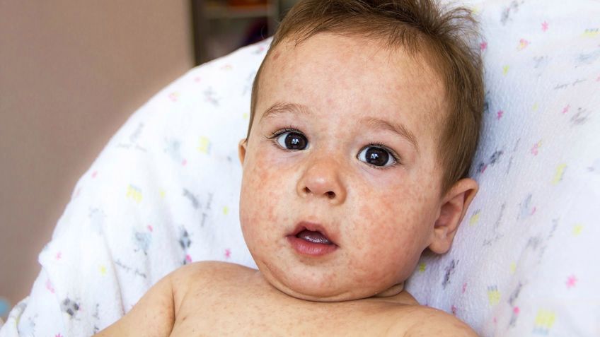 Charakterystycznym objawem odry jest wysypka