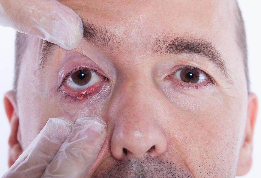 Pęcherz na oku może świadczyć o zakażeniu opryszczką.