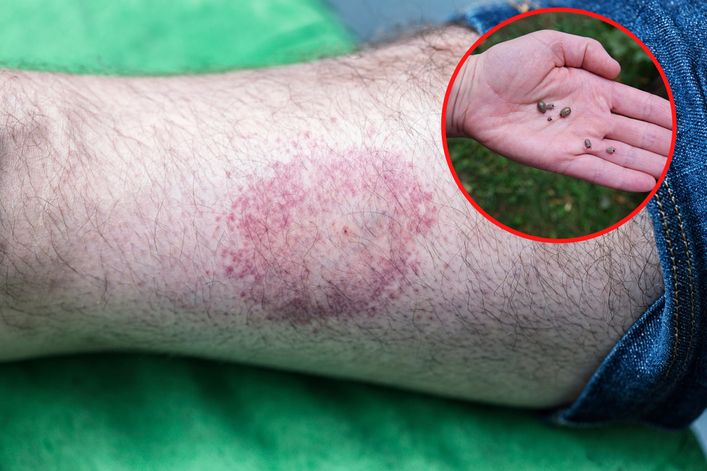 "Oko byka" pojawia się po ukąszeniu kleszcza. Jeśli je zauważysz, masz szczęście